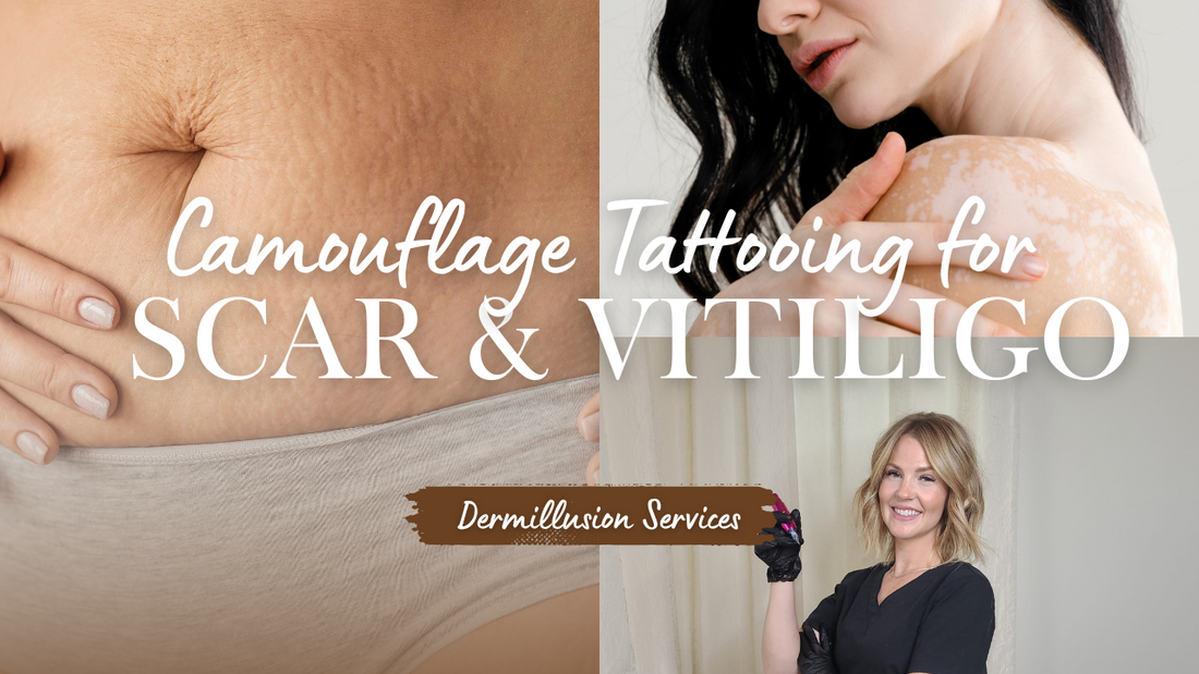 Camouflage Tattooing for Scar & Vitiligo : The Ultimate Guide to What Works | Dermillusion Services