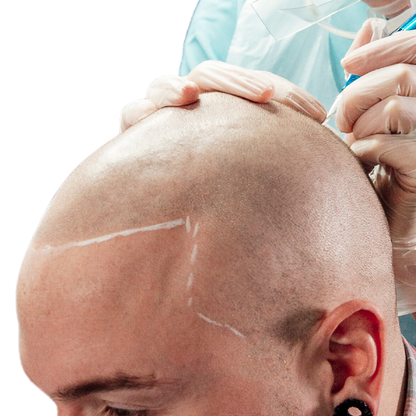 SCALP MICROPIGMENTATION