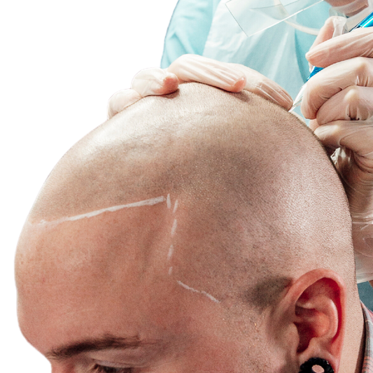 SCALP MICROPIGMENTATION